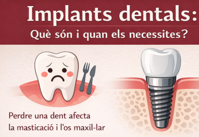 Implantes infografía Clínica Dental Arquer -h Implantes infografía Clínica Dental Arquer -h