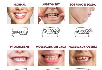 Oclusió dental per què és important controlar com encaixen les teves dents (1) Oclusió dental per què és important controlar com encaixen les teves dents (1)