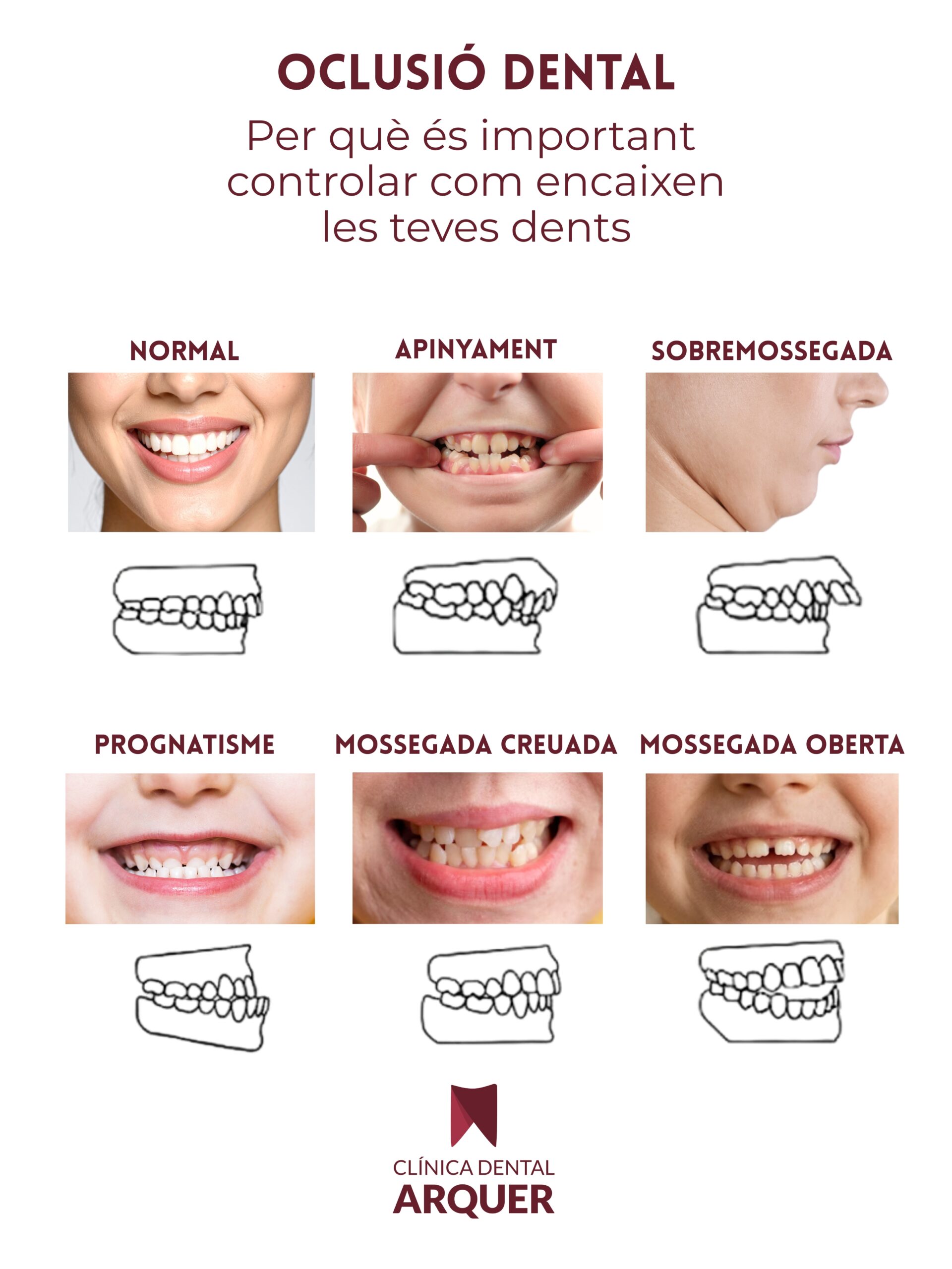Oclusió dental per què és important controlar com encaixen les teves dents (1)